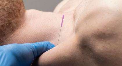 dry needling 